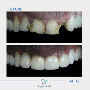 Copy of Beige Brown Neutral Before + After Instagram Post(1)